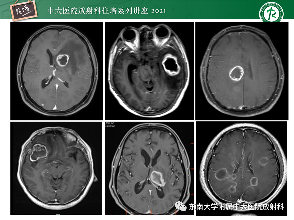 影像PPT - 【PPT】颅内环形强化病变的影像鉴别诊断-2