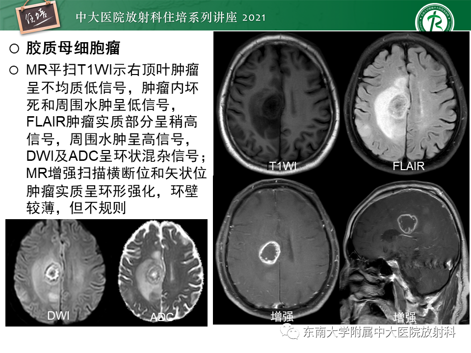 影像PPT - 【PPT】颅内环形强化病变的影像鉴别诊断-9