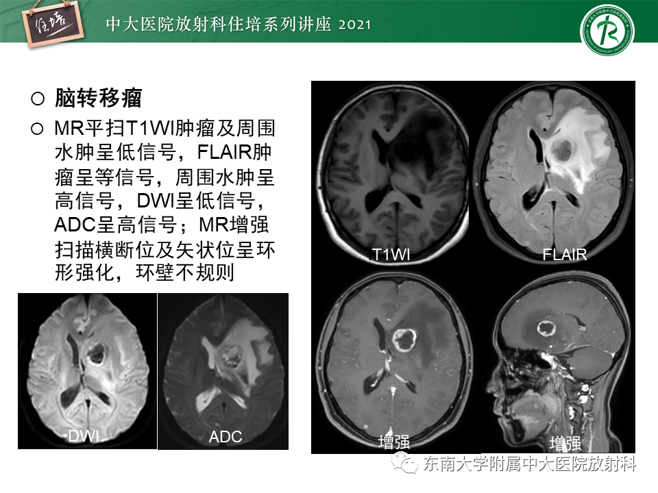 影像PPT - 【PPT】颅内环形强化病变的影像鉴别诊断-11