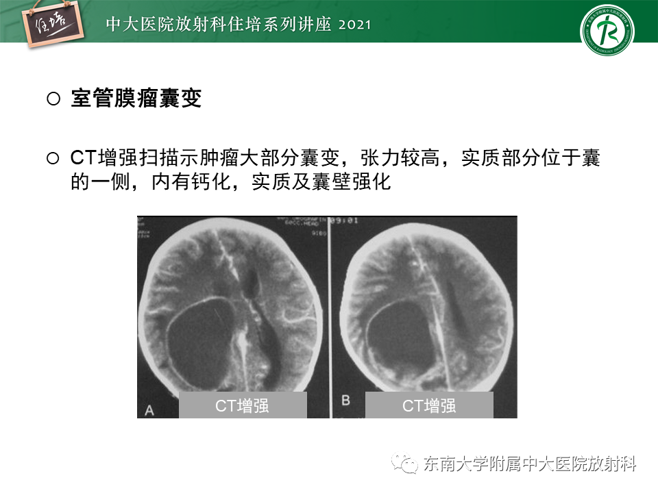 影像PPT - 【PPT】颅内环形强化病变的影像鉴别诊断-13