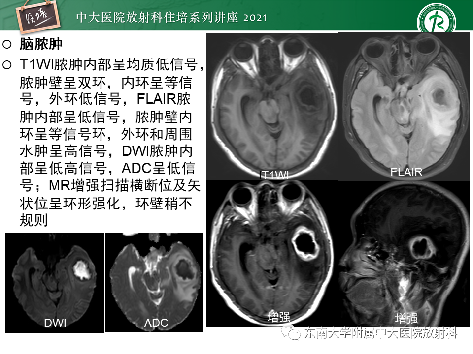 影像PPT - 【PPT】颅内环形强化病变的影像鉴别诊断-16