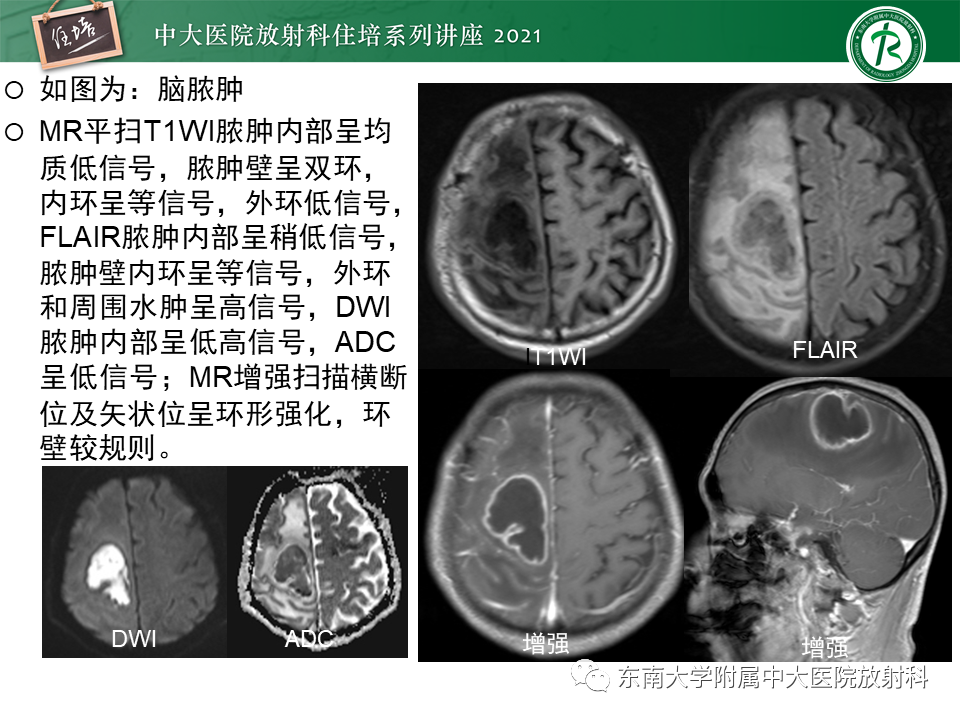 影像PPT - 【PPT】颅内环形强化病变的影像鉴别诊断-17