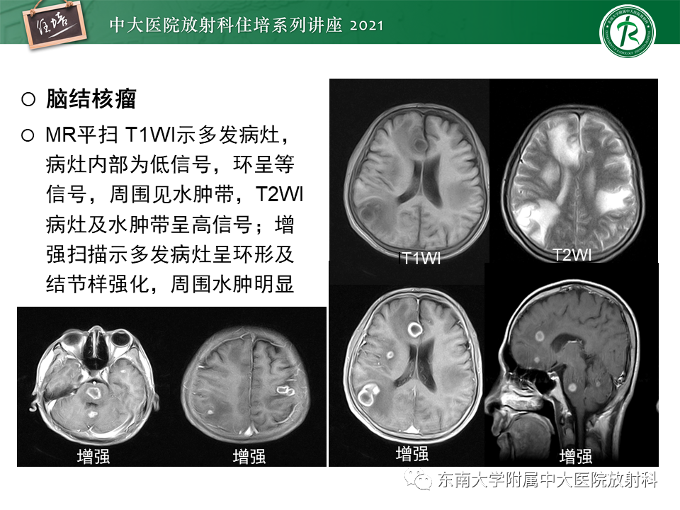 影像PPT - 【PPT】颅内环形强化病变的影像鉴别诊断-19
