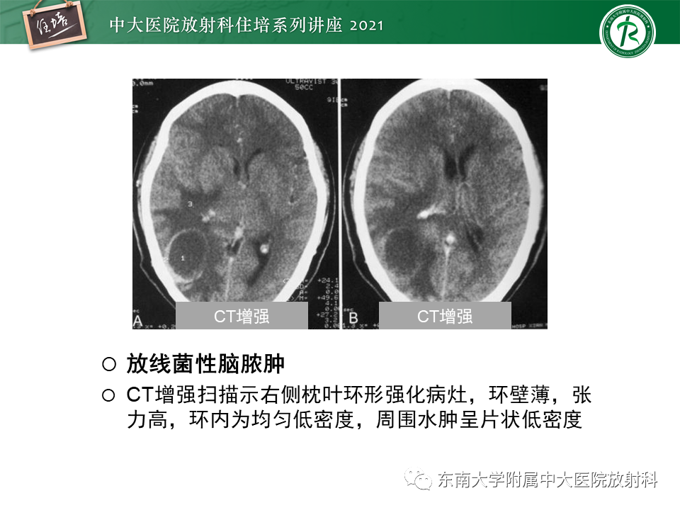影像PPT - 【PPT】颅内环形强化病变的影像鉴别诊断-22