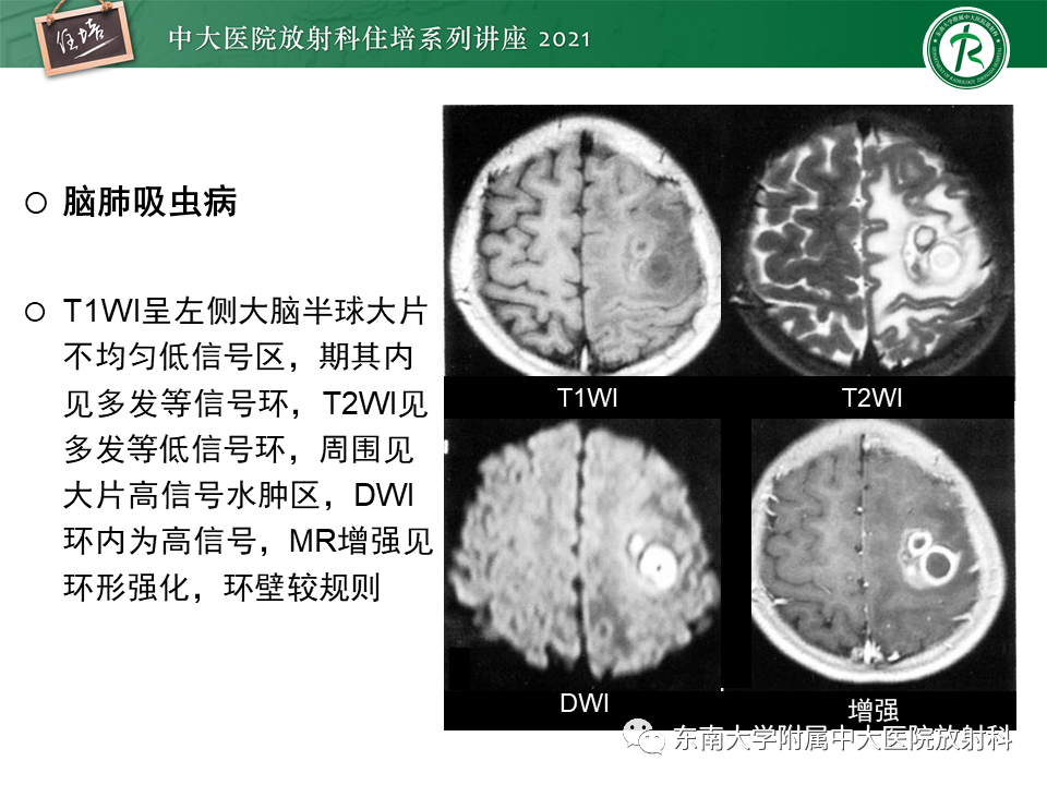 影像PPT - 【PPT】颅内环形强化病变的影像鉴别诊断-23