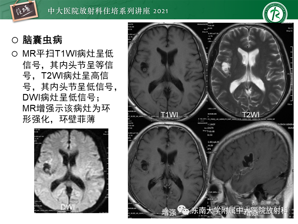 影像PPT - 【PPT】颅内环形强化病变的影像鉴别诊断-24