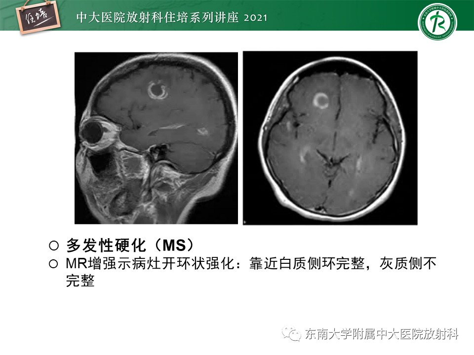 影像PPT - 【PPT】颅内环形强化病变的影像鉴别诊断-28