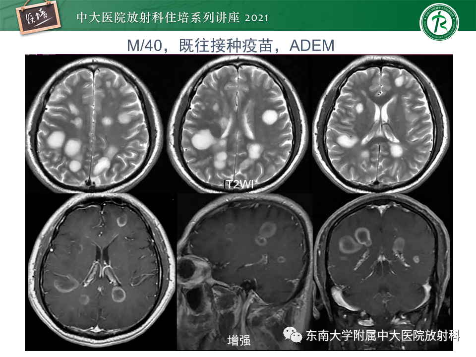 影像PPT - 【PPT】颅内环形强化病变的影像鉴别诊断-29