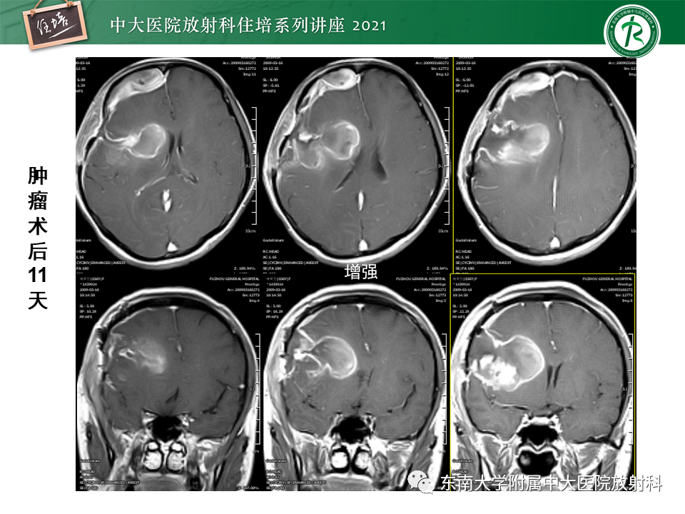 影像PPT - 【PPT】颅内环形强化病变的影像鉴别诊断-31