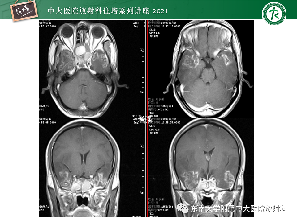影像PPT - 【PPT】颅内环形强化病变的影像鉴别诊断-33