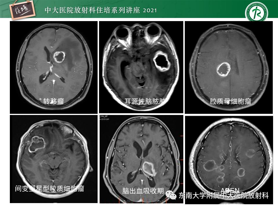 影像PPT - 【PPT】颅内环形强化病变的影像鉴别诊断-34