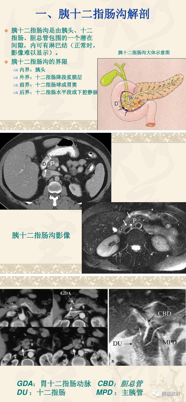 影像PPT - 【病例】沟槽区胰腺炎1例CT影像表现-9