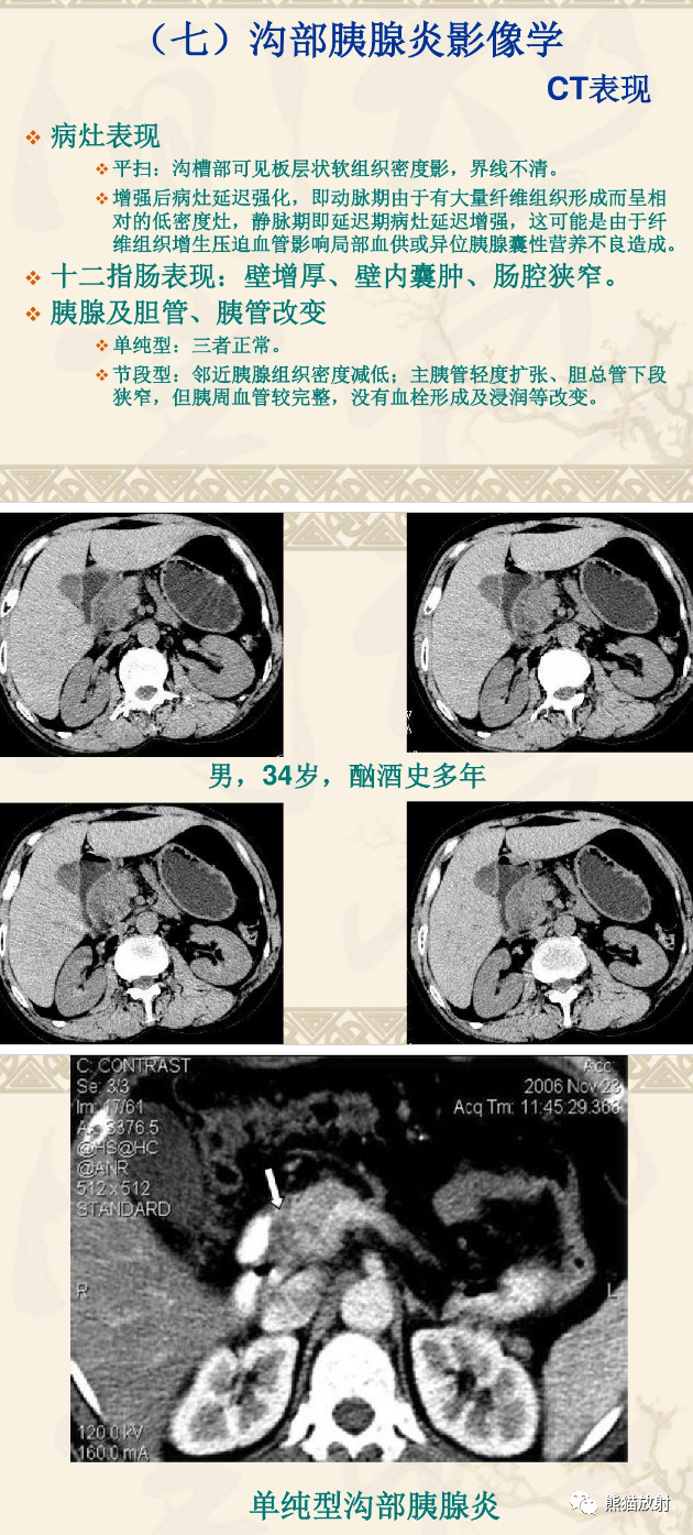 影像PPT - 【病例】沟槽区胰腺炎1例CT影像表现-12