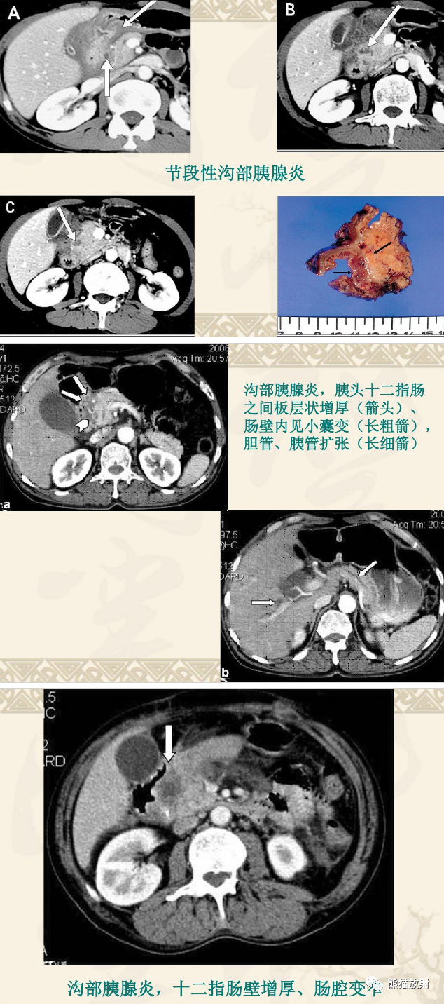 影像PPT - 【病例】沟槽区胰腺炎1例CT影像表现-13