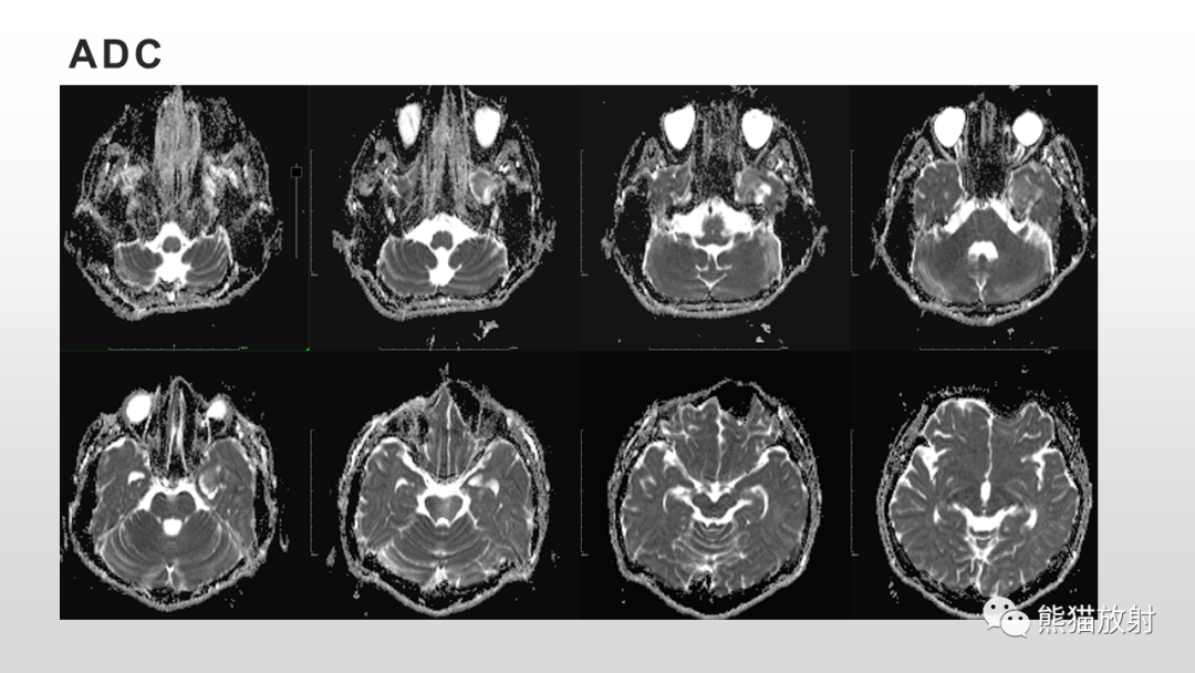 影像PPT - 【病例】多形性黄色星形细胞瘤2例MR影像-6