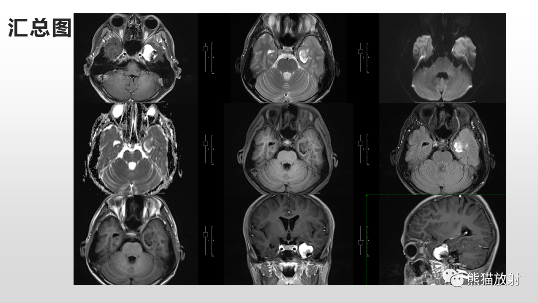 影像PPT - 【病例】多形性黄色星形细胞瘤2例MR影像-12