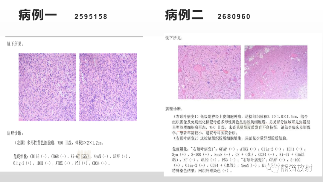 影像PPT - 【病例】多形性黄色星形细胞瘤2例MR影像-25