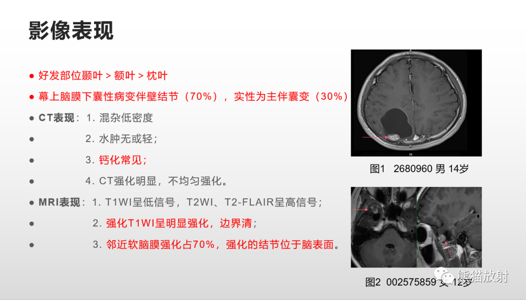 影像PPT - 【病例】多形性黄色星形细胞瘤2例MR影像-28
