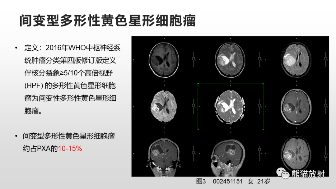 影像PPT - 【病例】多形性黄色星形细胞瘤2例MR影像-29