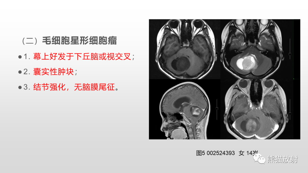 影像PPT - 【病例】多形性黄色星形细胞瘤2例MR影像-31