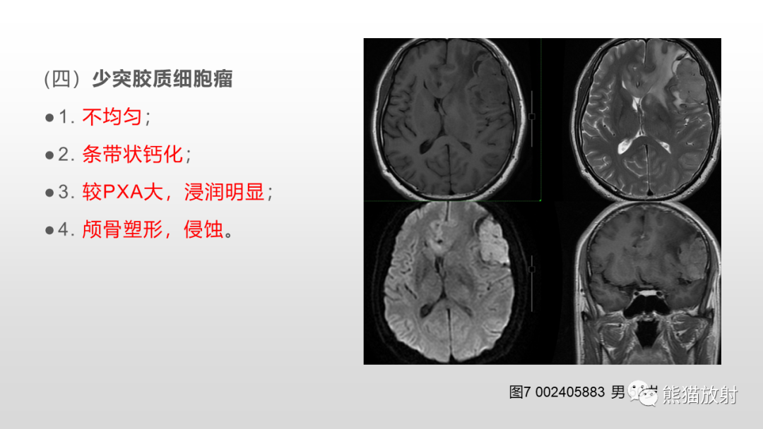 影像PPT - 【病例】多形性黄色星形细胞瘤2例MR影像-33