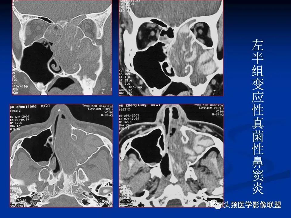 影像PPT - 【PPT】变应性真菌性鼻窦炎的影像表现-12