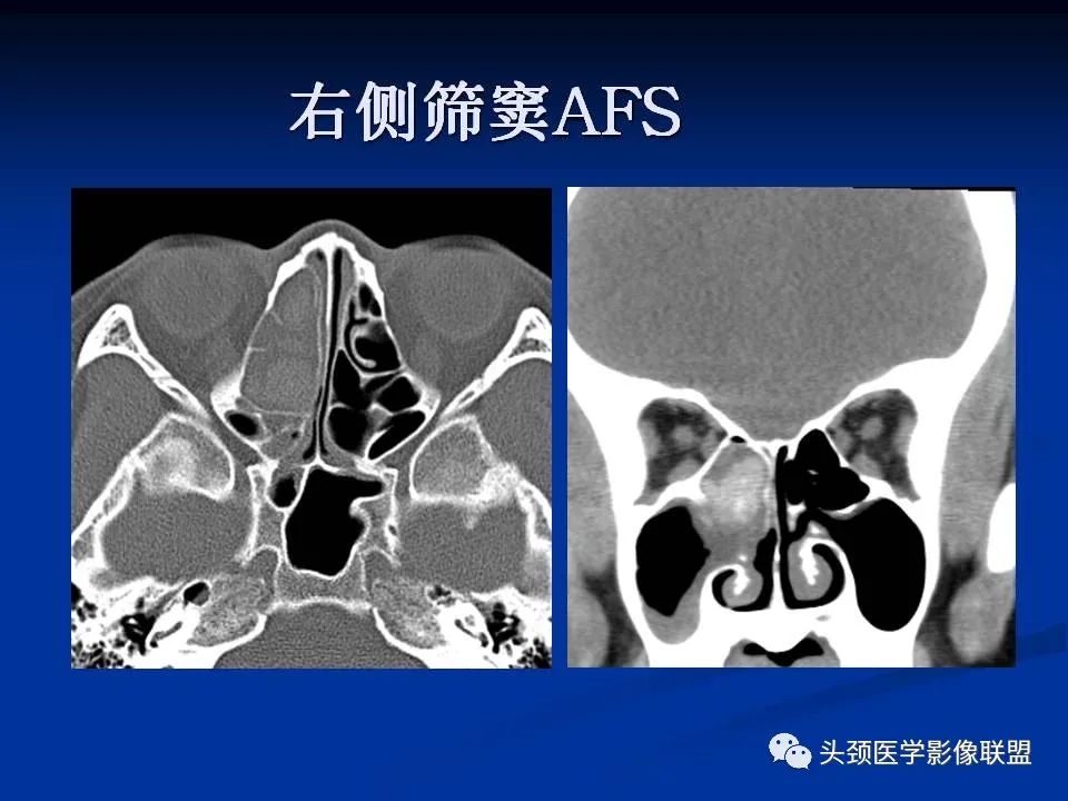 影像PPT - 【PPT】变应性真菌性鼻窦炎的影像表现-11