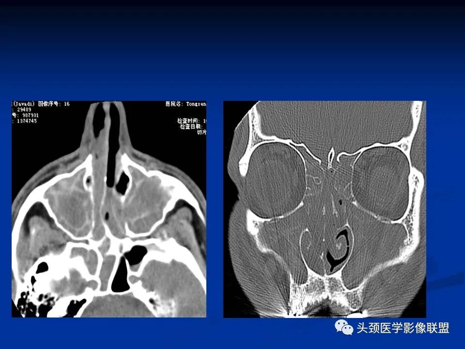 影像PPT - 【PPT】变应性真菌性鼻窦炎的影像表现-13