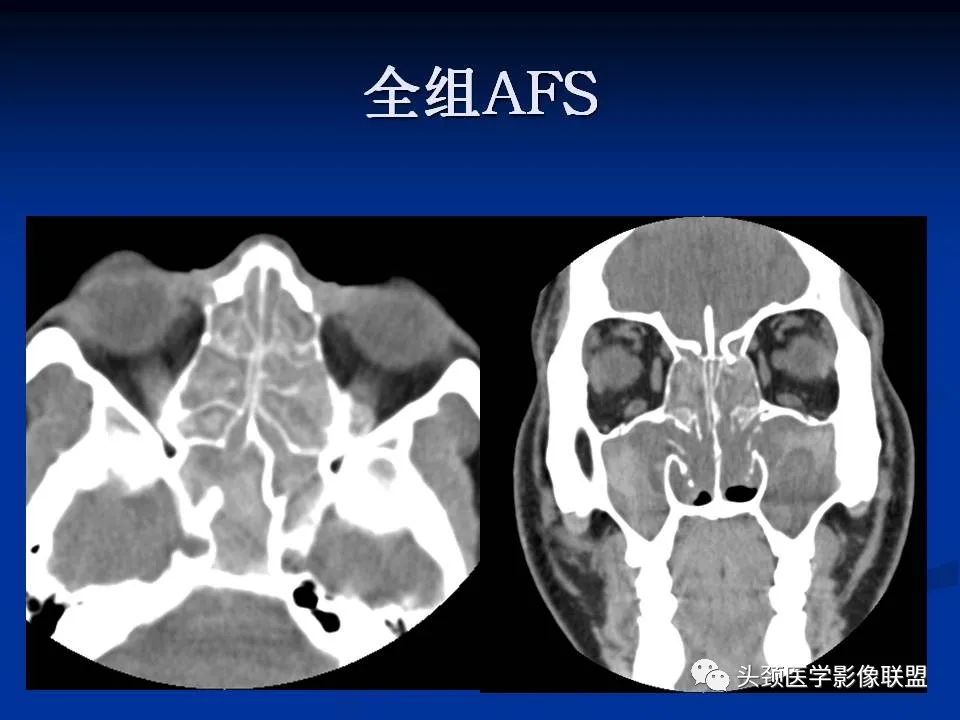 影像PPT - 【PPT】变应性真菌性鼻窦炎的影像表现-15