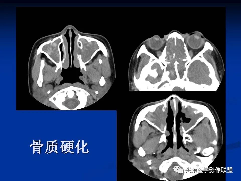 影像PPT - 【PPT】变应性真菌性鼻窦炎的影像表现-16