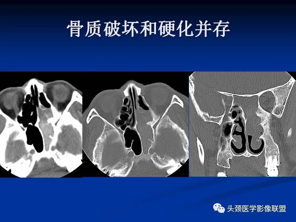 影像PPT - 【PPT】变应性真菌性鼻窦炎的影像表现-18