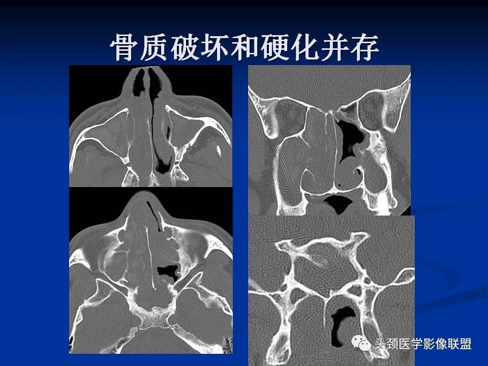 影像PPT - 【PPT】变应性真菌性鼻窦炎的影像表现-19