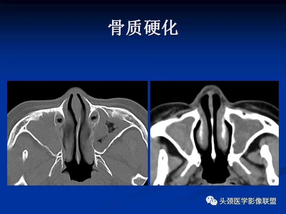 影像PPT - 【PPT】变应性真菌性鼻窦炎的影像表现-17