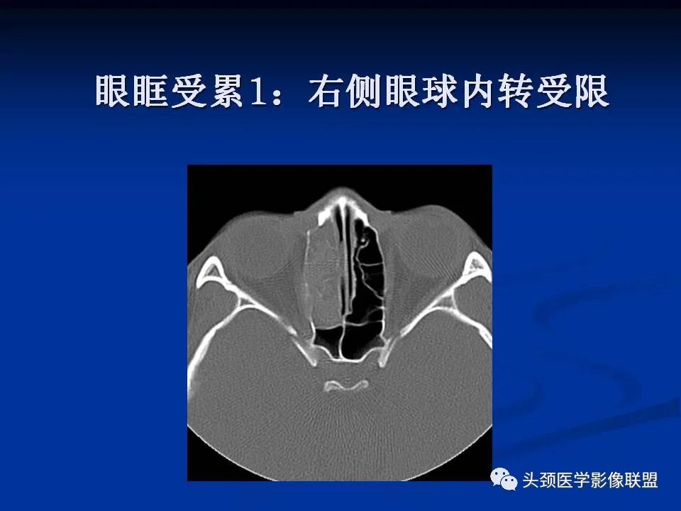 影像PPT - 【PPT】变应性真菌性鼻窦炎的影像表现-21