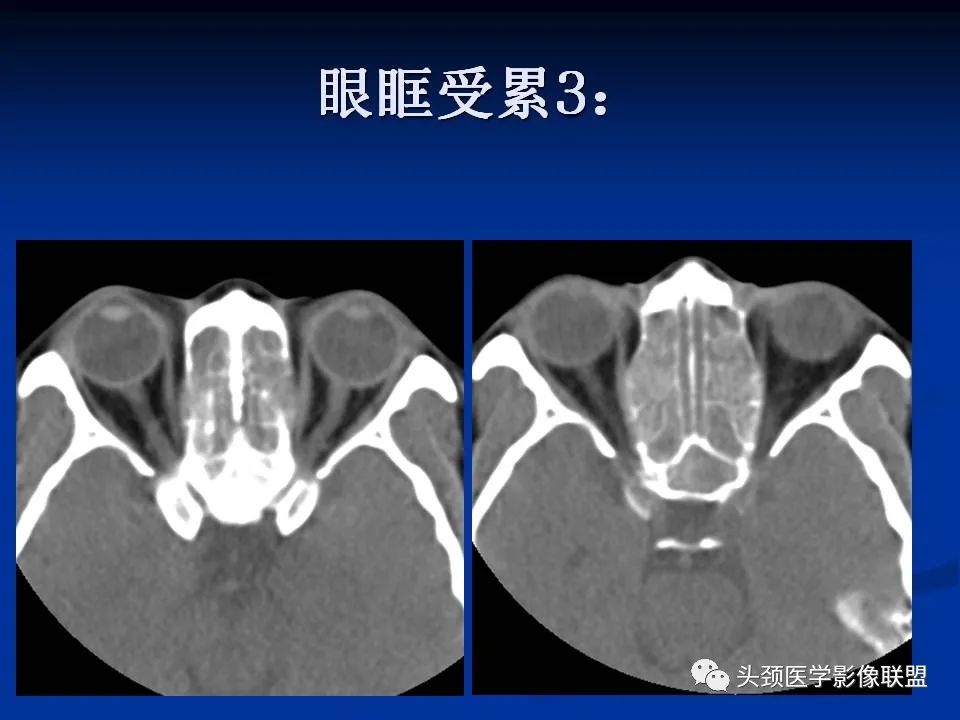 影像PPT - 【PPT】变应性真菌性鼻窦炎的影像表现-23