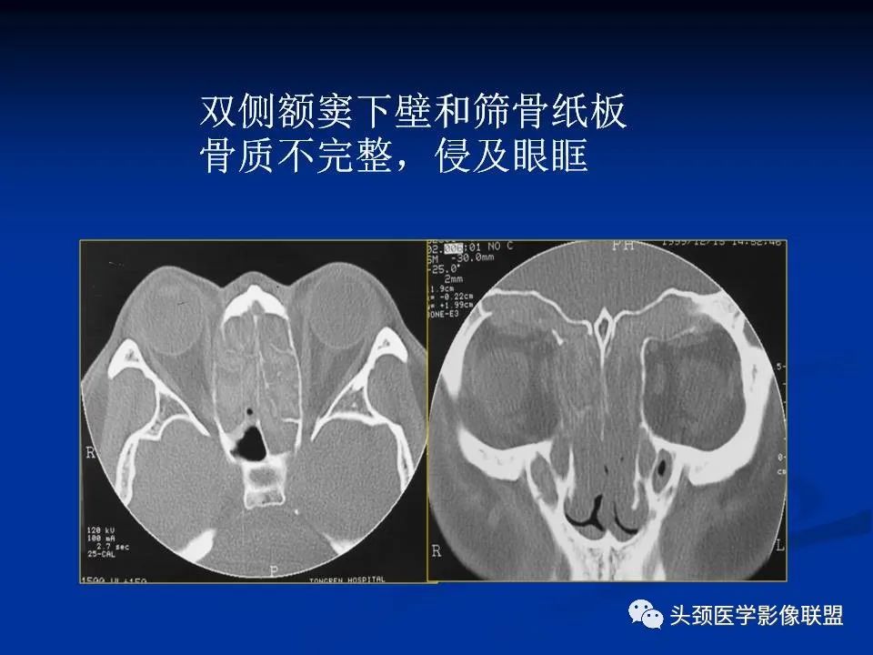 影像PPT - 【PPT】变应性真菌性鼻窦炎的影像表现-25