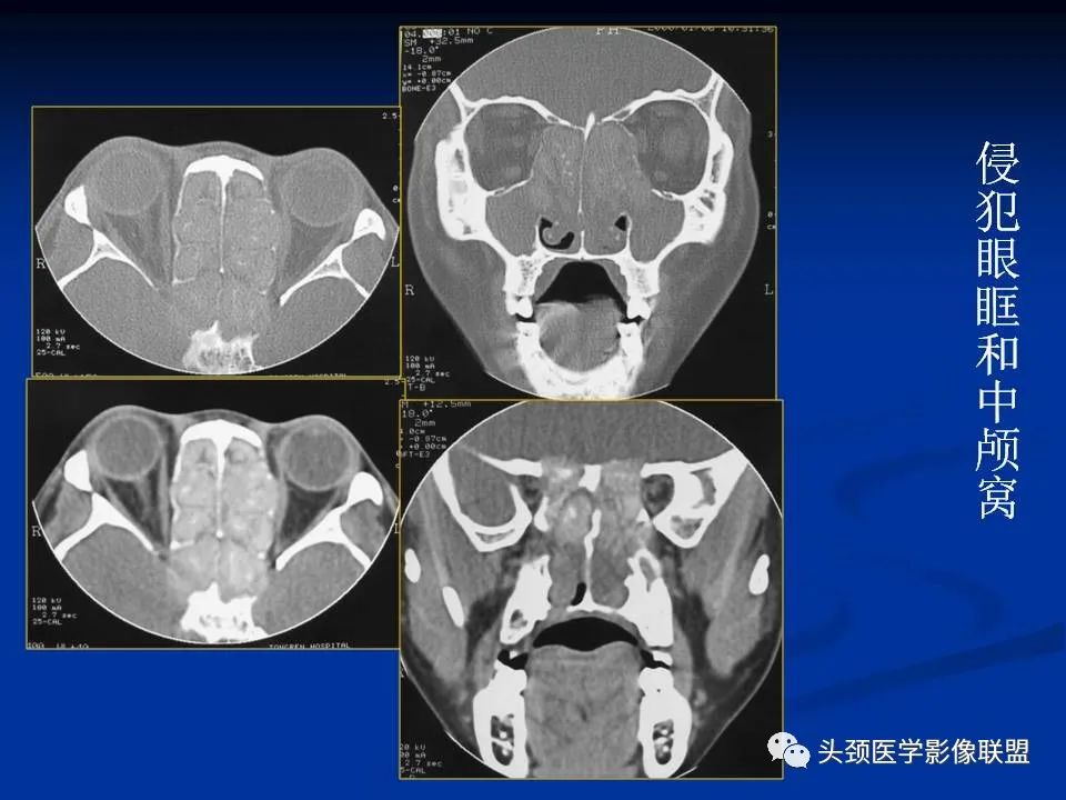 影像PPT - 【PPT】变应性真菌性鼻窦炎的影像表现-24