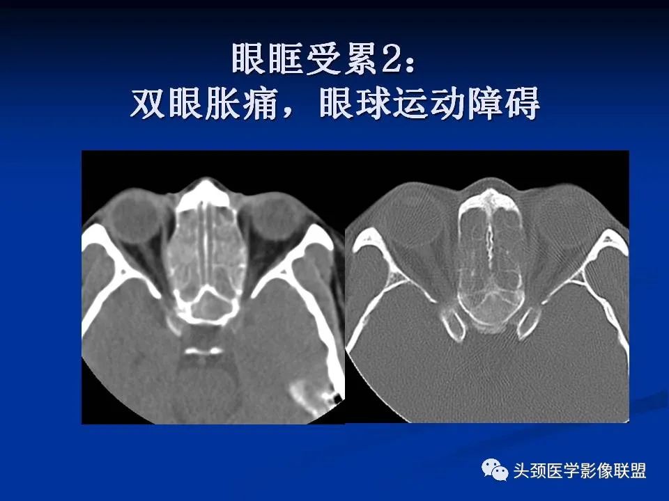 影像PPT - 【PPT】变应性真菌性鼻窦炎的影像表现-22
