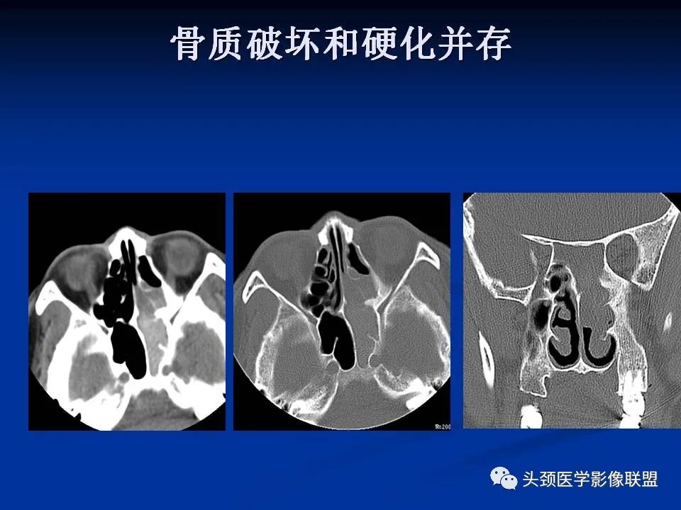 影像PPT - 【PPT】变应性真菌性鼻窦炎的影像表现-20