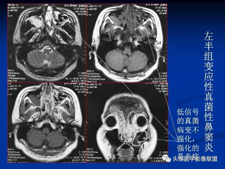 影像PPT - 【PPT】变应性真菌性鼻窦炎的影像表现-28
