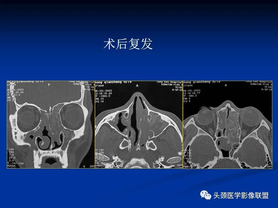影像PPT - 【PPT】变应性真菌性鼻窦炎的影像表现-27