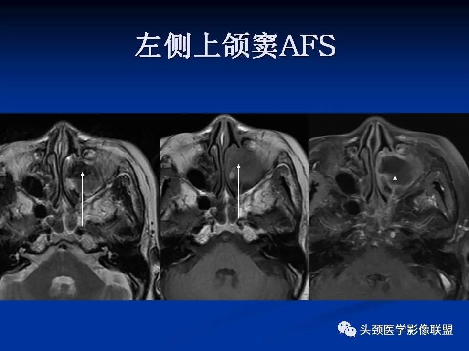 影像PPT - 【PPT】变应性真菌性鼻窦炎的影像表现-29