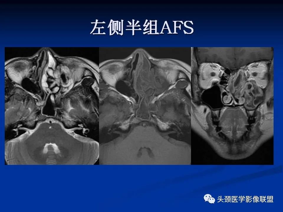 影像PPT - 【PPT】变应性真菌性鼻窦炎的影像表现-30