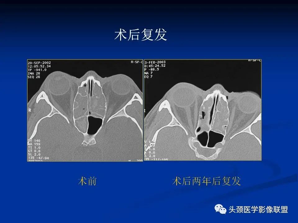 影像PPT - 【PPT】变应性真菌性鼻窦炎的影像表现-26