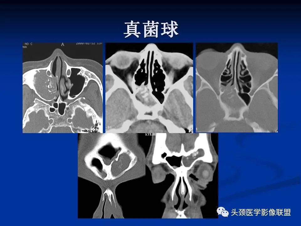 影像PPT - 【PPT】变应性真菌性鼻窦炎的影像表现-39