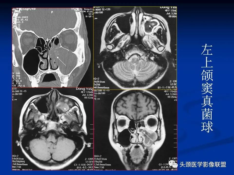 影像PPT - 【PPT】变应性真菌性鼻窦炎的影像表现-41