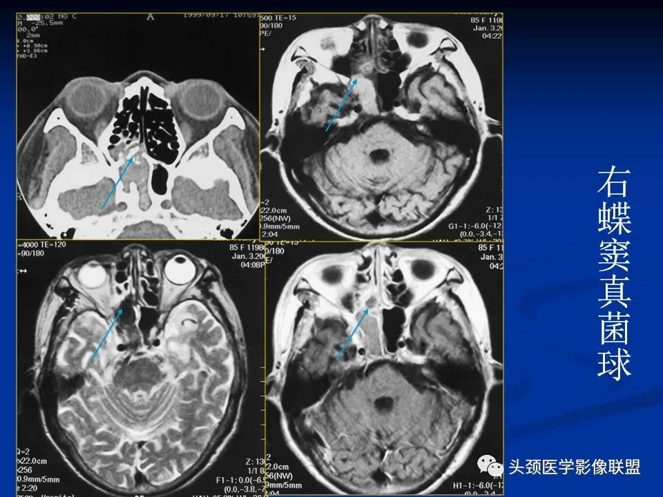 影像PPT - 【PPT】变应性真菌性鼻窦炎的影像表现-42