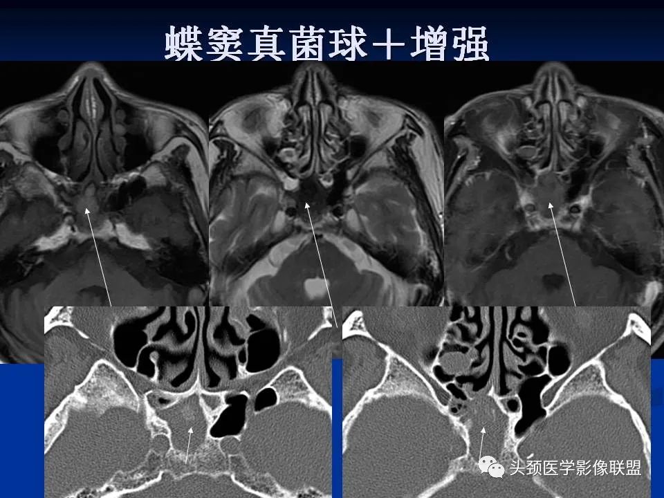 影像PPT - 【PPT】变应性真菌性鼻窦炎的影像表现-43