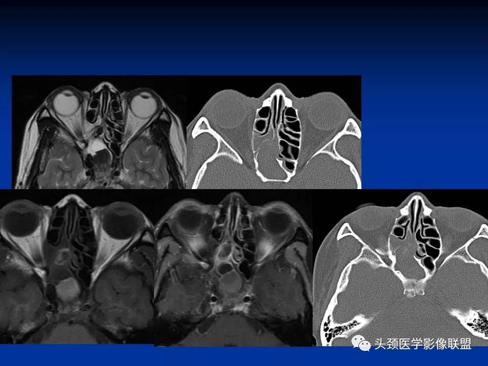 影像PPT - 【PPT】变应性真菌性鼻窦炎的影像表现-44