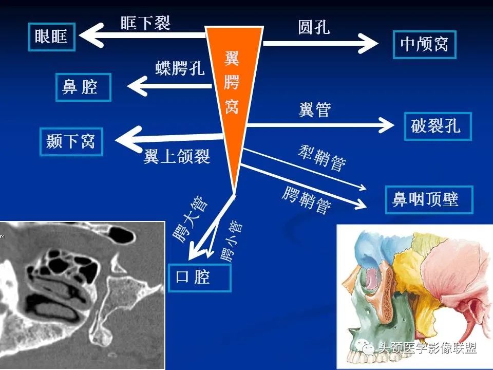 影像PPT - 【PPT】变应性真菌性鼻窦炎的影像表现-49